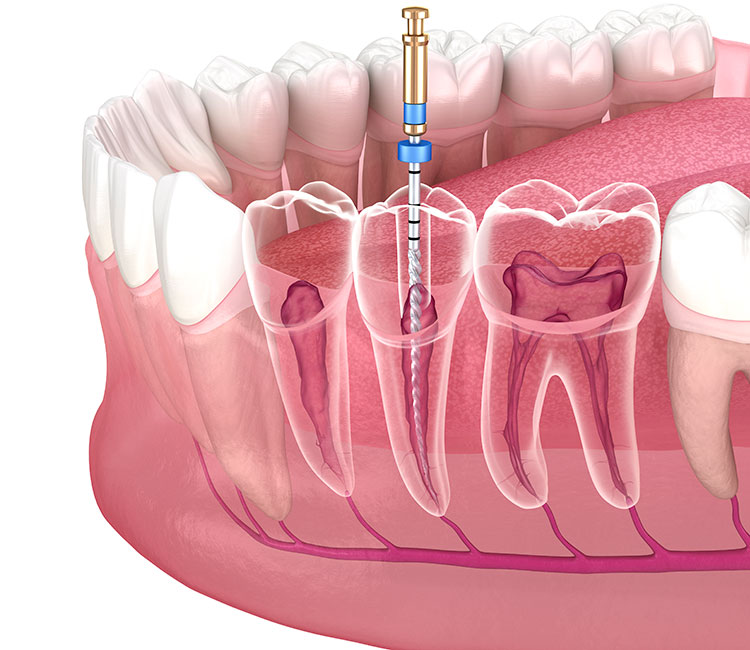 Endodontie - Traitement de canal Truchtersheim
