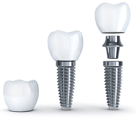 Implant dentaire Truchtersheim